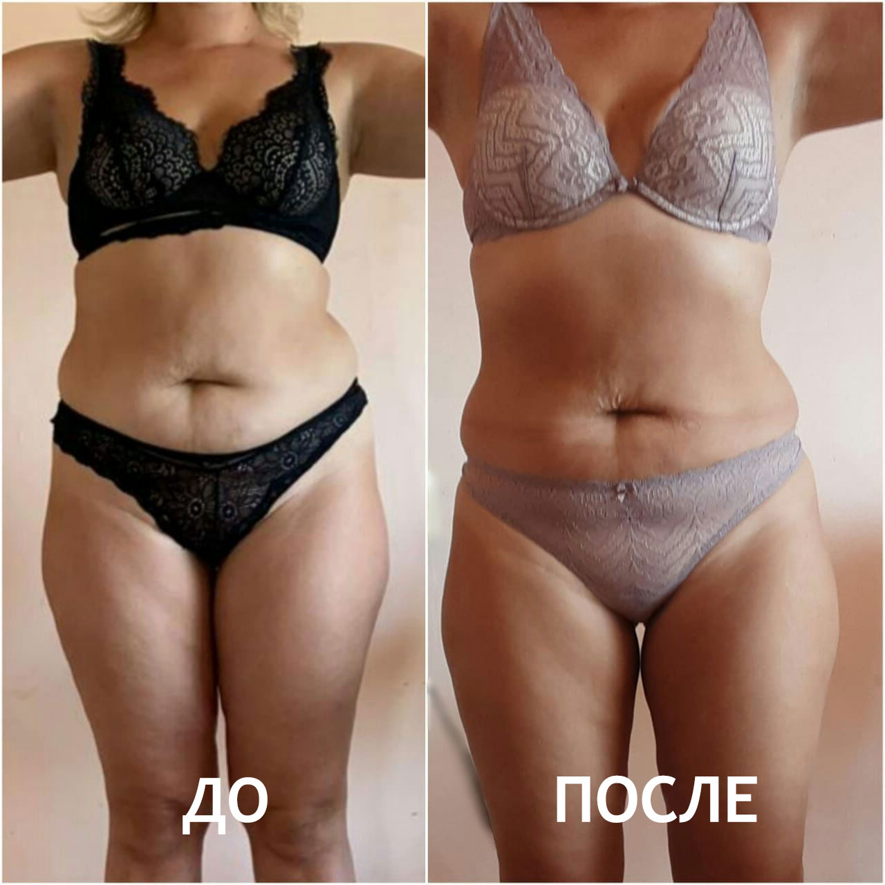 Антицеллюлитный массаж ДО и ПОСЛЕ