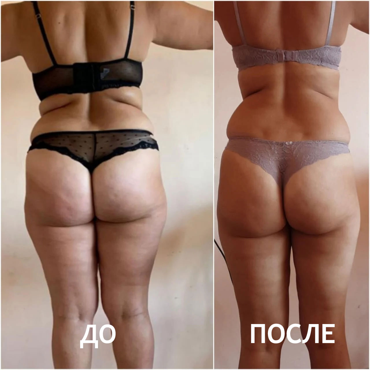 Антицеллюлитный массаж ДО и ПОСЛЕ