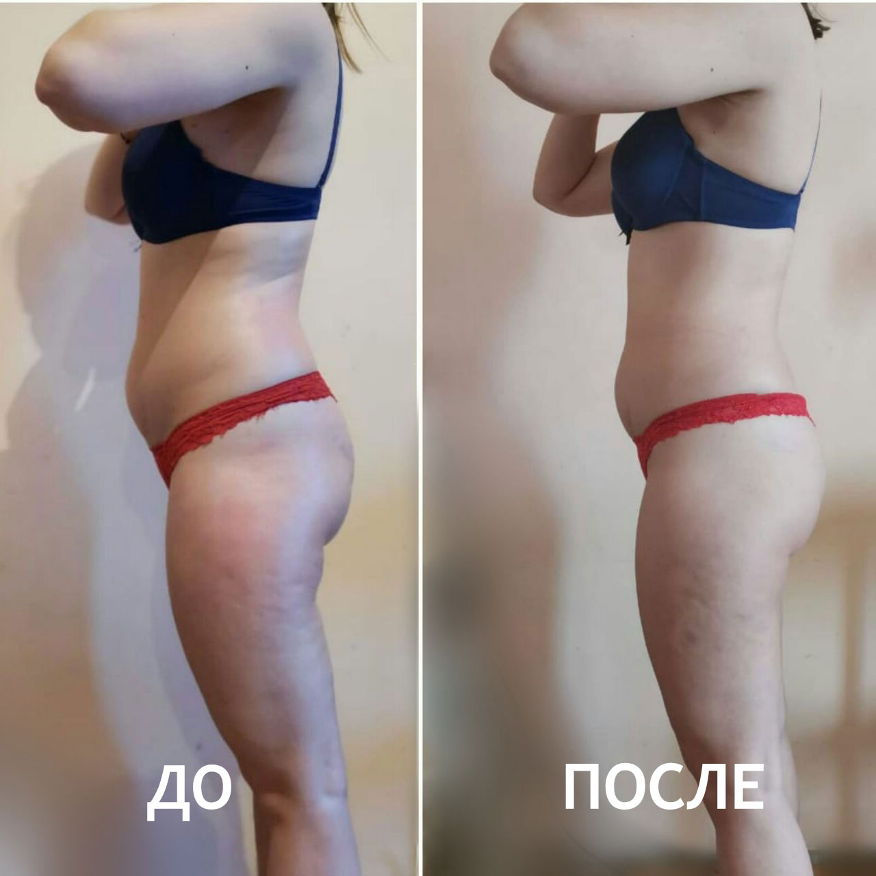 Вакуумный массаж ДО и ПОСЛЕ