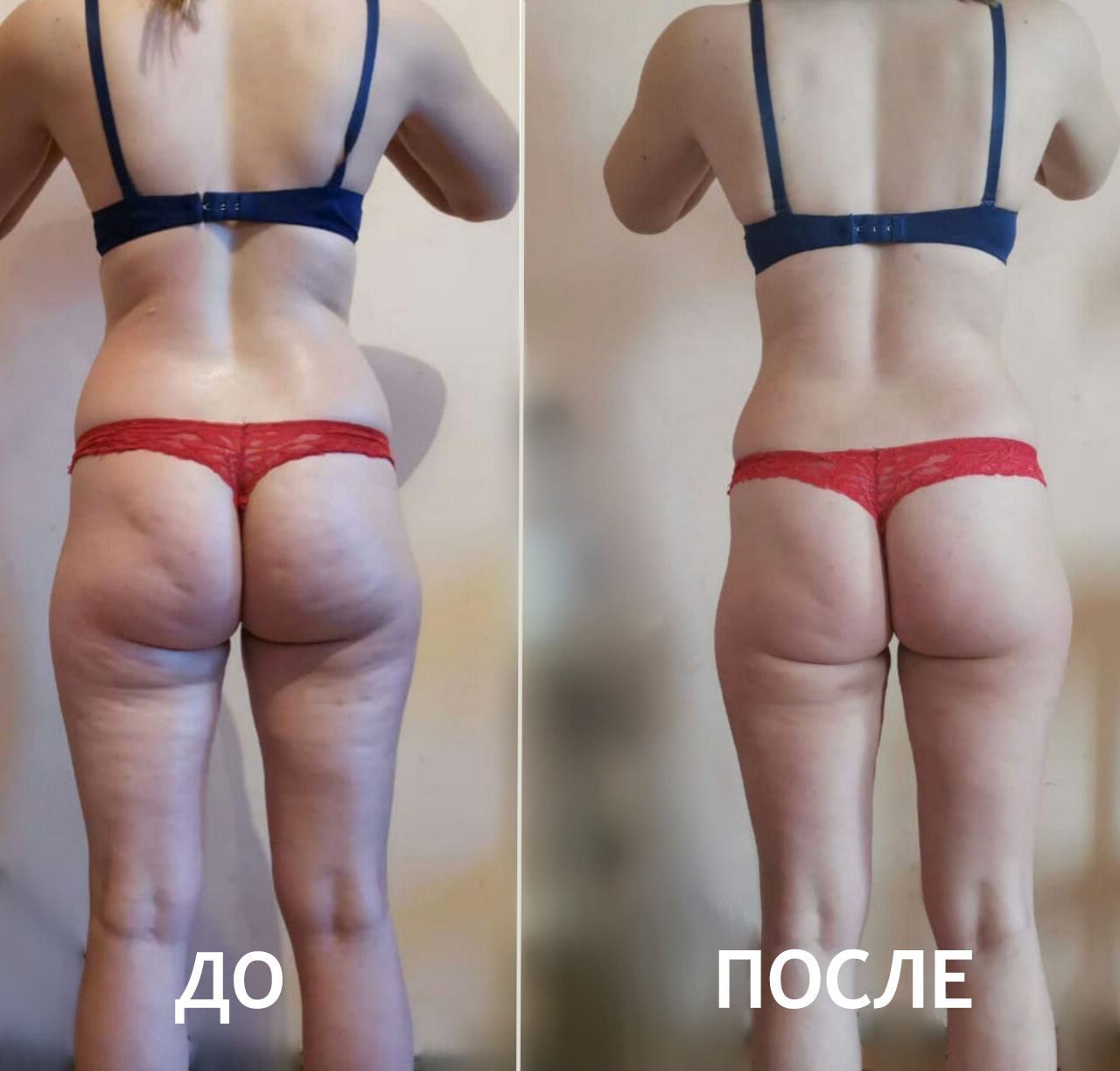 Вакуумный массаж ДО и ПОСЛЕ