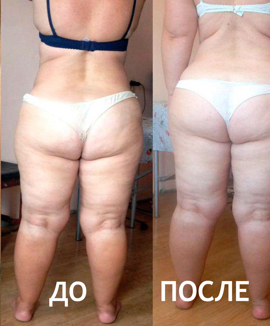 RF-лифтинг ДО и ПОСЛЕ